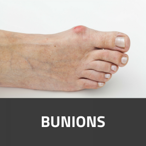 Bunions
