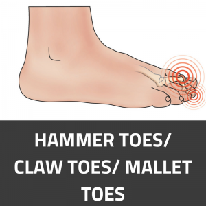 Hammer Toes/ Claw Toes/ Mallet Toes