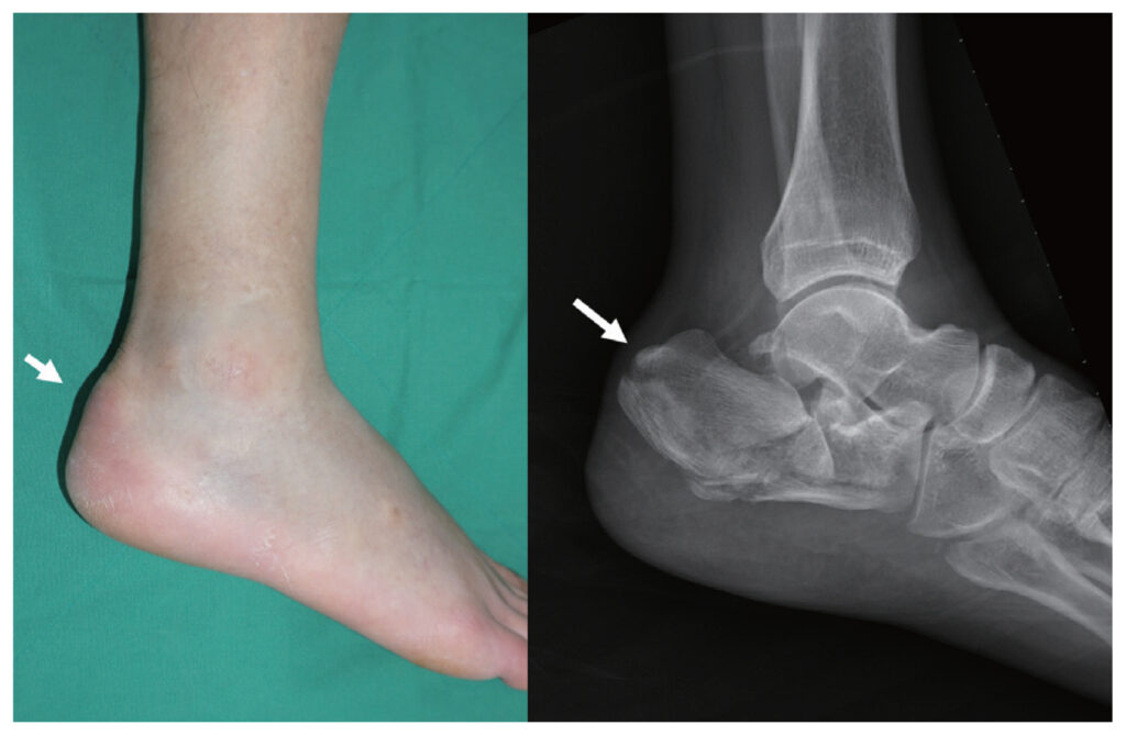 Calcaneal Fractures