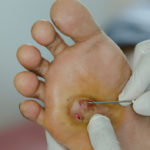 Diabetic Wound Care