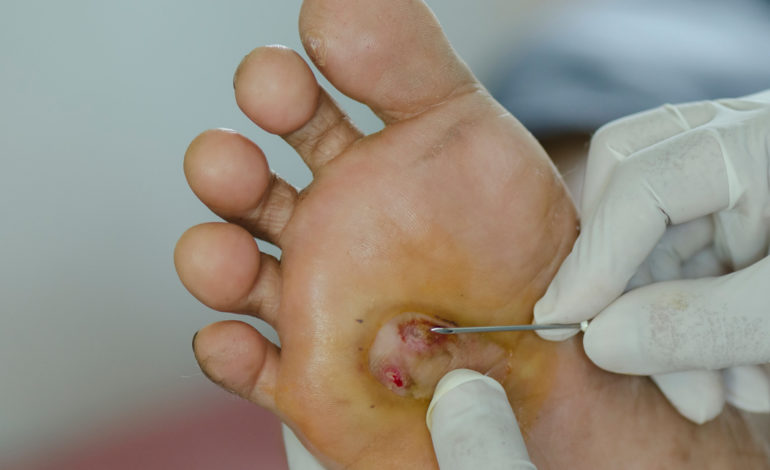 Diabetic Wound Care