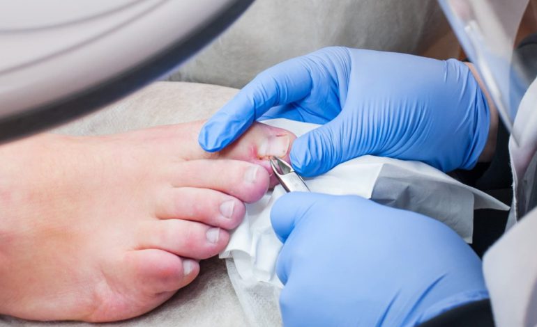 Ingrown Toenail Removal